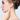 Отопластика (otoplasty)