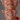 implant denture in Marmaris